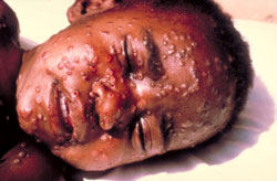 Symptom of Smallpox: Lesions